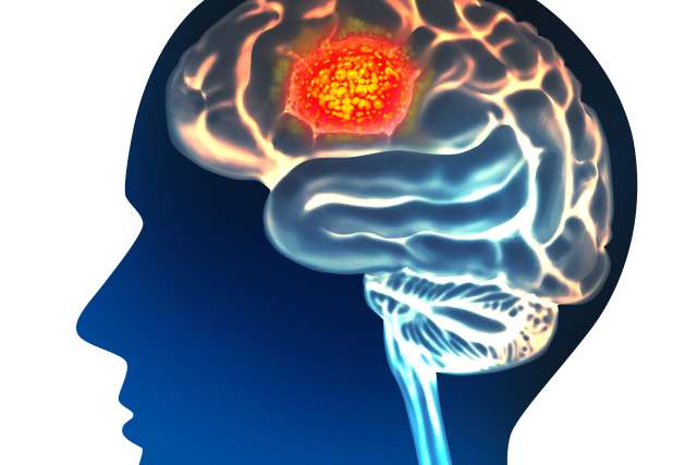 Graphic of glioblastoma