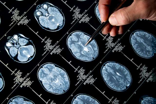 A doctor points his pen at an MRI scan.