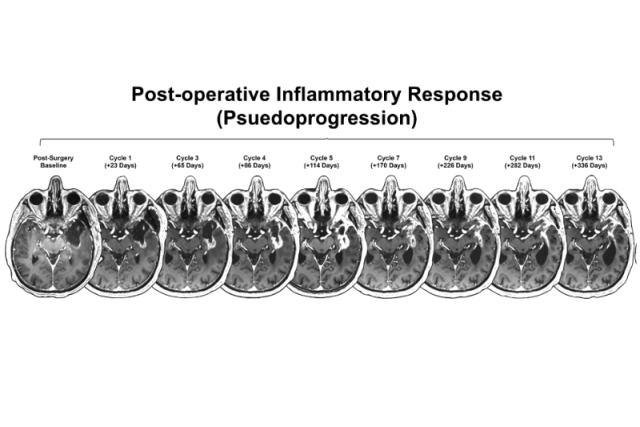 Axial brain scans showing evolving post-operative inflammatory response (pseudoprogression)