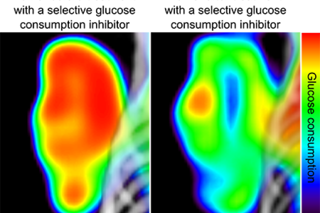 Cancer metabolism glucose consumption captured by heat scan.