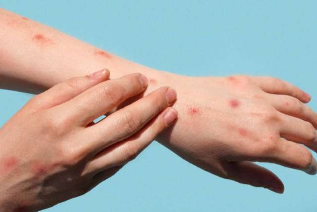 Red, circular lesions consistent with Monkeypox (or similar rash) on the forearm and back of two hands against a blue background.