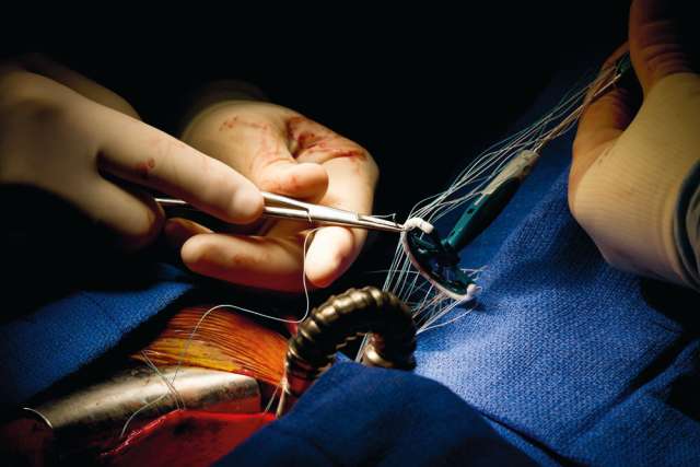 heart valve