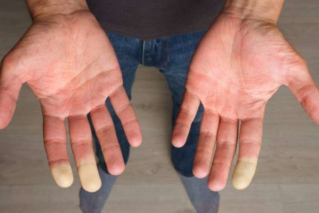 Raynaud's phenomenon