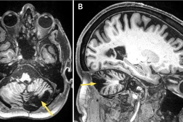 Brain MRI of post-stroke cerebellar lesion.