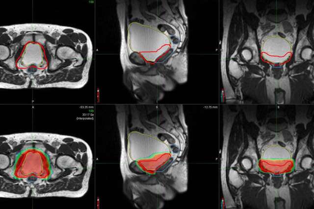 MRI scans showing cross-sectional views with outlined areas in red and green.