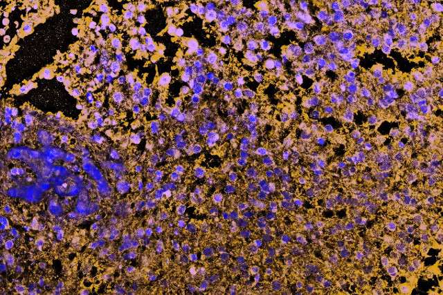 glioblastoma cells