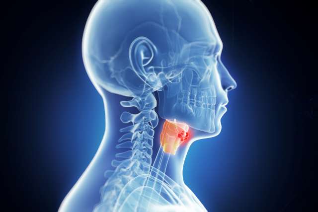 throat tumor illustration