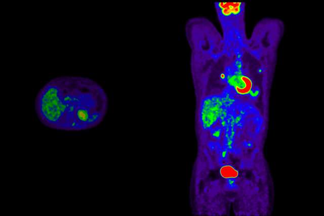 PET/CT scan for nuclear medicine