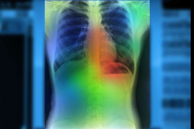 Lung cancer imaging