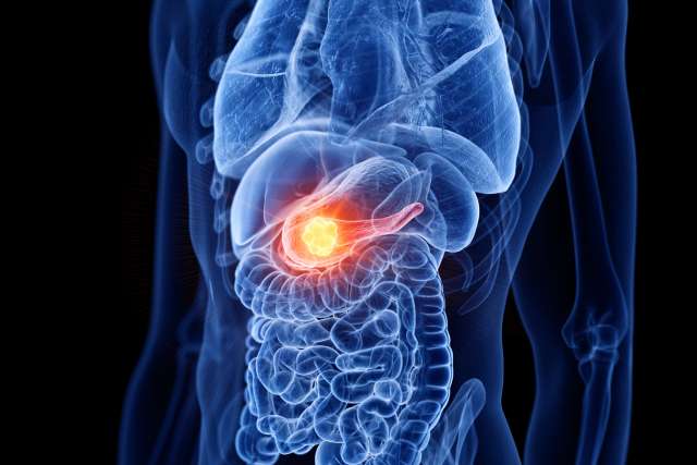 3d rendered medically accurate illustration of pancreas cancer