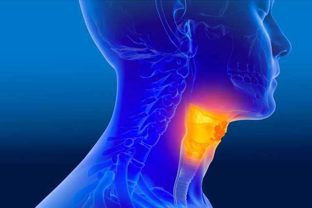 Throat cancer