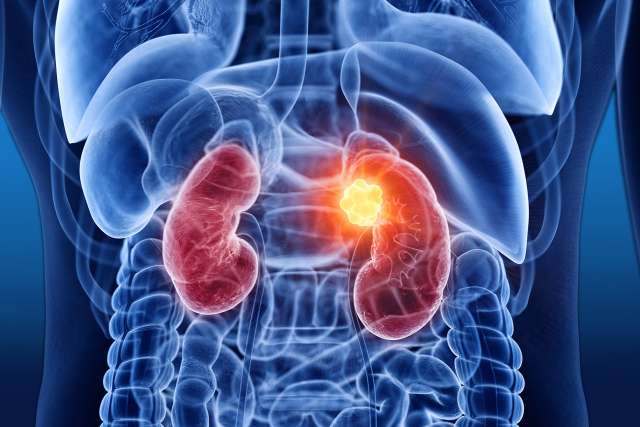 Kidney cancer