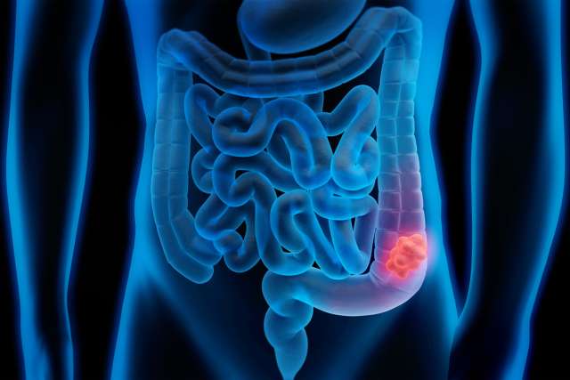 Medical illustration of Colorectal Cancer