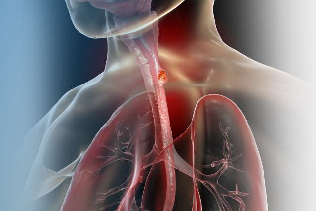 Esophageal cancer, 3D illustration showing malignant tumor in the human esophagus