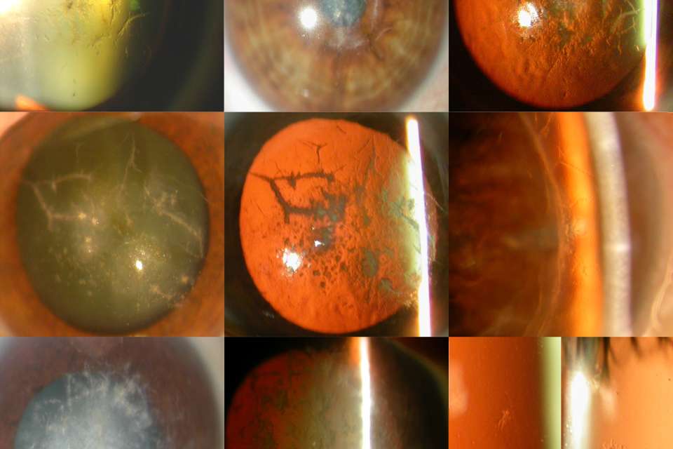 Cornea Distrophies figure_1.jpg