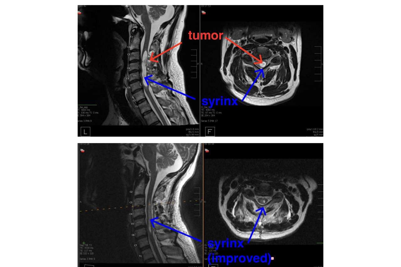 Before and after MRI of spinal tumor removal