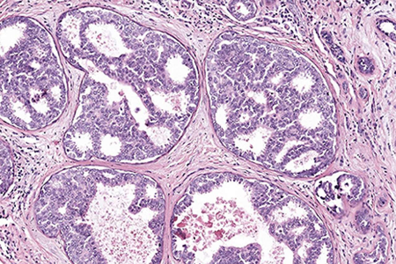 https://www.uclahealth.org/images/newsphotos/DCIS-from-Elmore-Lab.jpg DCIS from Elmore Lab