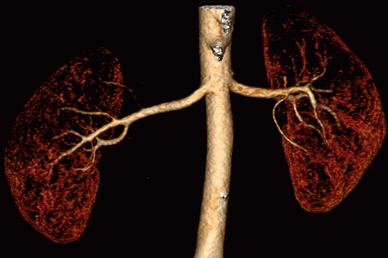 Q3D Lung Animation
