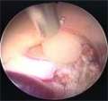 Colloid Cyst