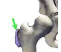 Trochanteric diagram