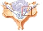 Epidural Corticosteroid Injection