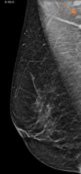 Case: Axillary Lymphadenopathy  Figure 1