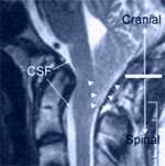 Arnold Chiari Malformation