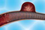 Brain aneurysm illustrated