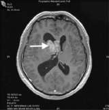 Pre Operative RMI Ependymoma