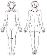 Fibromyalgia chart