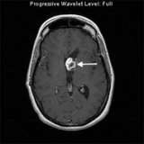 Juvenile Pilocytic Imaging