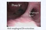 Internal photo of Mid-Esophagus