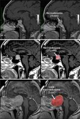 X-ray of Pituitary adenomas