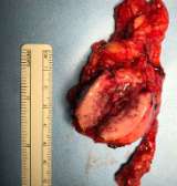 Pheochromocytoma Removed