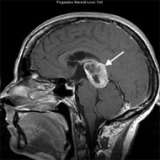 Pinea Tumor