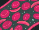 Sickle Cell