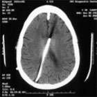 Slit Ventricle Syndrome