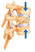 Spinal Compression Fractures