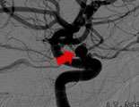 Lateral view before coil embolization