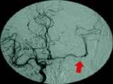 Angiograph after rTPA procedure