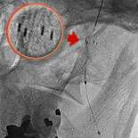 Atherosclerosis Surgery Figure 2