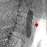 Atherosclerosis Surgery Figure 3