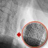 Atherosclerosis Surgery Figure 4