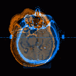 CT scan