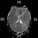 Perfusion Map after rTPA procedure