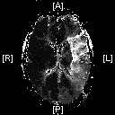 Perfusion Map before rTPA procedure