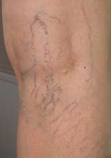 Spider Veins