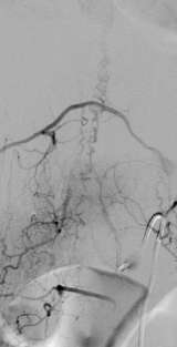 Figure 2: Spinal Dural AVF