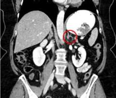 Adrenal tumor