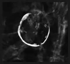 Rim Calcifications